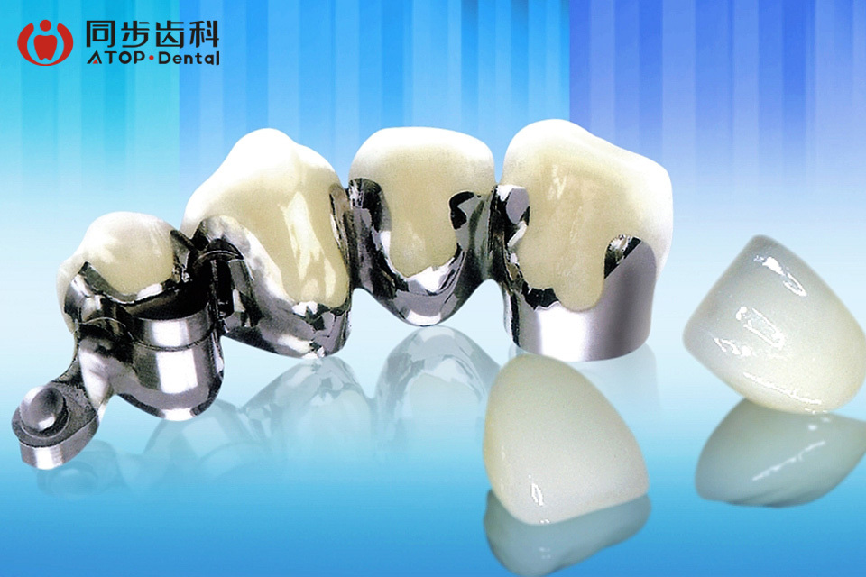 深圳烤瓷牙团购,深圳烤瓷牙打折优惠,深圳烤瓷