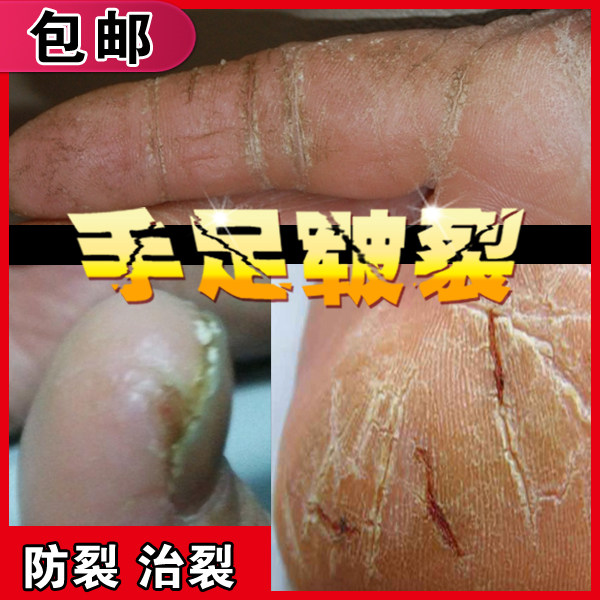 手足皲裂膏防裂膏修复脚跟膏手裂脚裂口脚后跟干裂开裂手霜龟裂膏