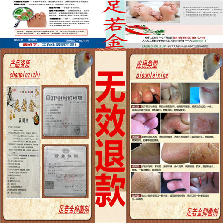 腳癢治療速效手癬水泡感染脫皮癢真菌止癢膏手足癬鵝掌風藥膏腳臭在類目 本地化生活服務, 健康服務, 足浴/洗浴/按摩中 - 來自Buy2taobao.com提供專業的淘寶代購服務
