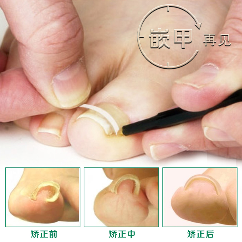 生命立嵌甲矫正器脚指甲矫形脚趾甲纠正卷甲矫正贴片正甲贴片甲沟|ruв категории личный уход/Здравоохранение/массажное оборудование, похудения, уход гвоздь устройство - от Buy2taobao.com для оказания профессиональной услуги покупки агента Taobao