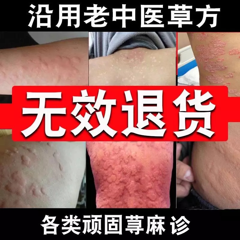 慢性荨麻疹断根中药荨麻疹丸正品中药龙泰荨麻疹专治外用专用药膏在类目 本地化生活服务, 健康服务, 足浴/洗浴/按摩中 - 来自Buy2taobao.com提供专业的淘宝代购服务