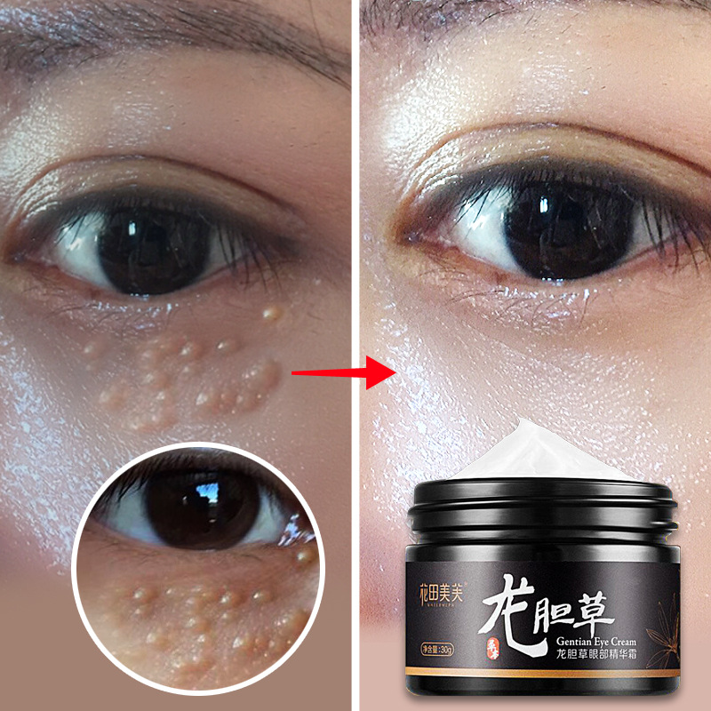 龙胆草脂肪粒去除神器眼霜膏特效脸眼部去脂肪粒膏油脂粒眼部精华|ruв категории Средства для ухода за собой, офтальмологических (новый), крем - от Buy2taobao.com для оказания профессиональной услуги покупки агента Taobao