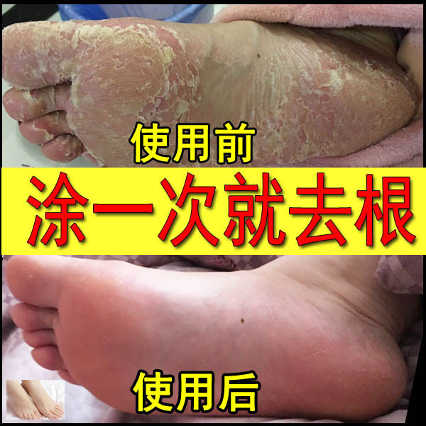 腳氣花安樂噴劑雲南白藥祛腳氣複方水楊酸溶液外用謝輝腳氣王正品在類目 本地化生活服務, 健康服務, 足浴/洗浴/按摩中 - 來自Buy2taobao.com提供專業的淘寶代購服務