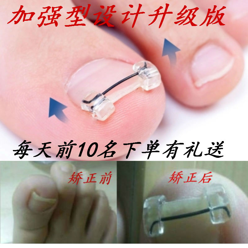 Upgraded version Ingrown Toenails Orthotic device Toenail Correct nail Orthotics Patchin the Family/Personal Cleaning Tools , Personal care cleaning appliances , Nail clippers/Nail clippers , Nail/Manicure Set category - from Buy2taobao.com to provide professional Taobao agent buy service