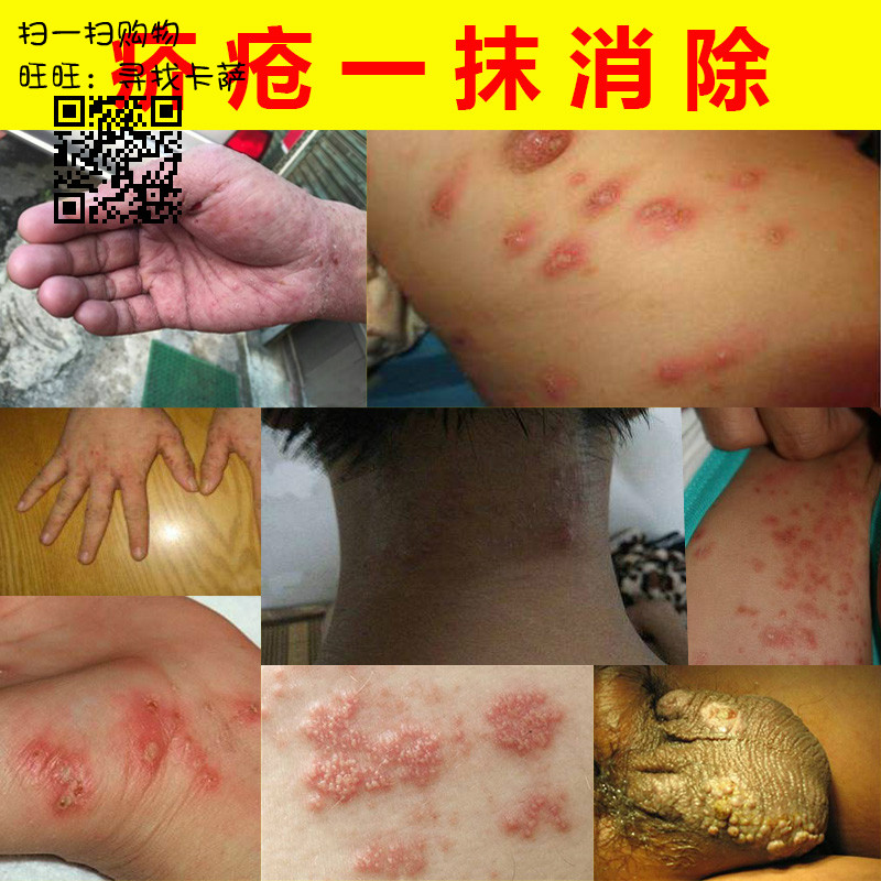 疥虫干疮膏干疮子除疥虫特效止痒外用一扫光绝疥膏虫卵膏草本乳膏在类目 洗护清洁剂/卫生巾/纸/香薰, 驱虫用品, 灭鼠/杀虫剂中 - 来自Buy2taobao.com提供专业的淘宝代购服务