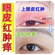 眼皮癣红肿发痒起皮眼周疼过敏皮炎，消炎有碎屑，眼角痒止痒抗菌干涩