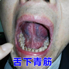 舌下口腔溶栓液喷剂舌下青筋黑紫粗血管堵塞舌头淤血一喷溶舌底