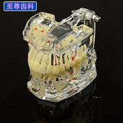牙科模型牙齿病理模型医患，沟通口腔教学成人，牙水晶模型修复模型