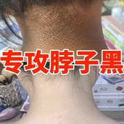 脖子黑色素去颈部美白脖子颈面膜去颈纹去黑去脖子黑洗不干净神器