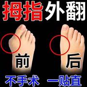 大母指头矫正可以穿n鞋改善大脚骨分趾器成人足大脚趾拇指外翻贴