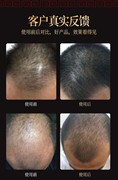 修正防脱生发洗发水育发密发脂溢性秃顶遗传性产后脱发头发增长液