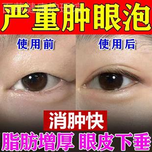 消肿眼贴肿泡消脂上眼皮松弛提拉紧致眼部脂肪厚眼睛水肿红肿专用