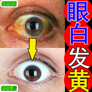 眼睛去黄去红血丝眼贴修复眼睛红缓解眼疲劳干涩发痒流泪充血神器