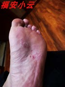 脚底板发白脚气红穆大夫足跟干裂药膏脚后跟护理膏手裂脚裂皮肤粗