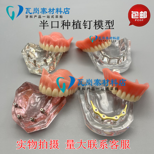 牙科模型口腔种植模型种植体，解说义齿修复对比种植钉球帽杆卡导板