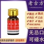 点痣 祛痣
