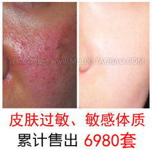 中药脱敏抗敏感性肌肤青黛敏安修护霜过敏皮肤修复荨麻疹舒缓特效