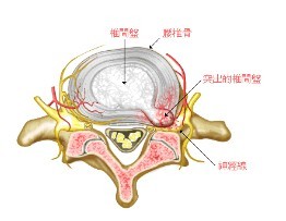 三神膏药 腰椎间盘突出 骨质增生 腰肌劳损 膨出