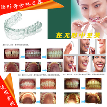 隐形牙齿矫正牙套矫正器定做 矫正后反弹 牙齿间隙 暴牙 牙齿不齐