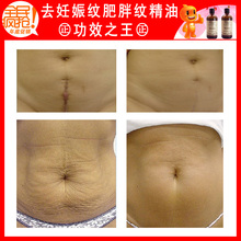 去妊娠纹精油正品产后消除妊辰纹祛除肥胖纹修复特效产品 买2送一