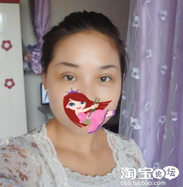 <em>韩式微创双眼皮</em>恢复过程 二十天 更新中. - 整形