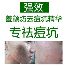 镇店之宝！羞颜坊纯中药超强去痘坑精华祛痘坑痘疤凹洞修复