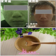 中医 纯中药面膜粉 祛痘印 消炎去痘面膜粉 男士面膜 四包免邮