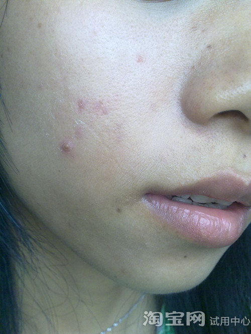 迟来的报告~黛依美雷涛祛痘效果好!_春冬