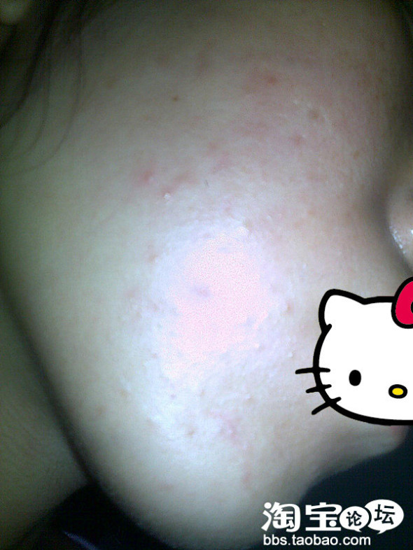 急 求助,脸上长米粒大小的疙瘩用粉刺针能挤出