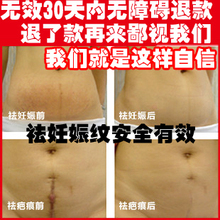 去妊娠纹精油 去妊辰纹 肥胖纹 产后修复消除 无效退款包邮
