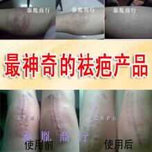 泰国强效祛疤痕烫伤疤痕灵手术伤疤修复祛痘印痘疤精油膏正品包邮