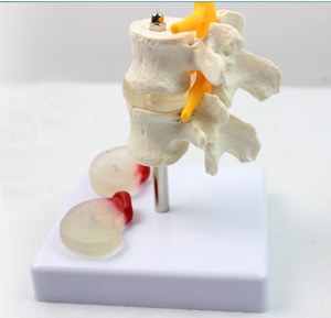 ENOVO颐诺人体腰椎病变椎间盘模型 腰椎模型