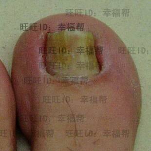 灰指甲 灰指甲脚气特效药 灰指甲无效退款 AME灰指甲专用药亮甲
