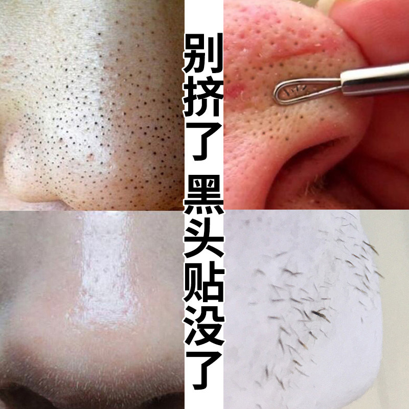 海洋诗韵去黑头收缩毛孔套装祛黑头鼻贴粉刺撕拉式鼻贴男女学生