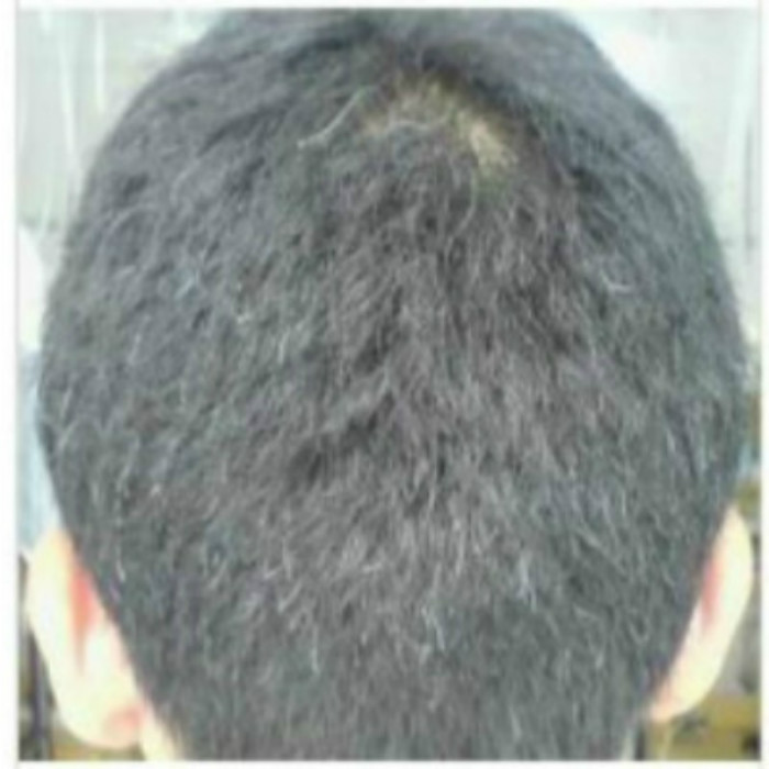 中药 <em>白发</em> 少白头变黑/<em>遗传</em>性<em>白发</em>/中年早白/白