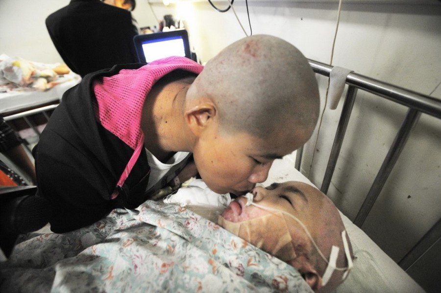 6岁女童烧伤 养母捐<em>整块</em>头皮 - 天天正能量