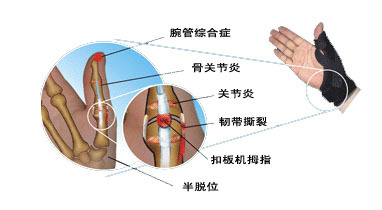 正品Medex拇指硬套H04稳定性拇指骨折\/掌腕关