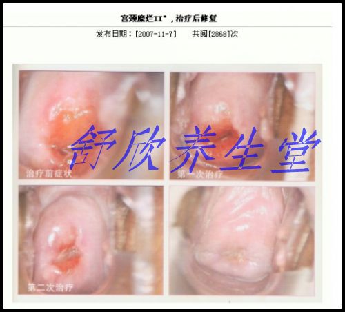 妇科病臭氧治疗仪器 妇科治疗仪根除妇科疾病
