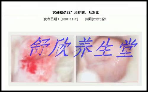 妇科病臭氧治疗仪器 妇科治疗仪根除妇科疾病