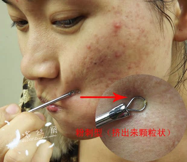 美容院专用 喀丝丽 特效清粉刺祛痘膏 拨毒 祛痘 修复 清粉刺_美容院专用 喀丝丽 特效清粉刺祛痘膏 拨毒 祛痘 修复 清粉刺价格_美容院专用 喀丝丽 特效清粉刺祛痘膏 拨毒 祛痘 修复 清粉刺图片_淘宝__