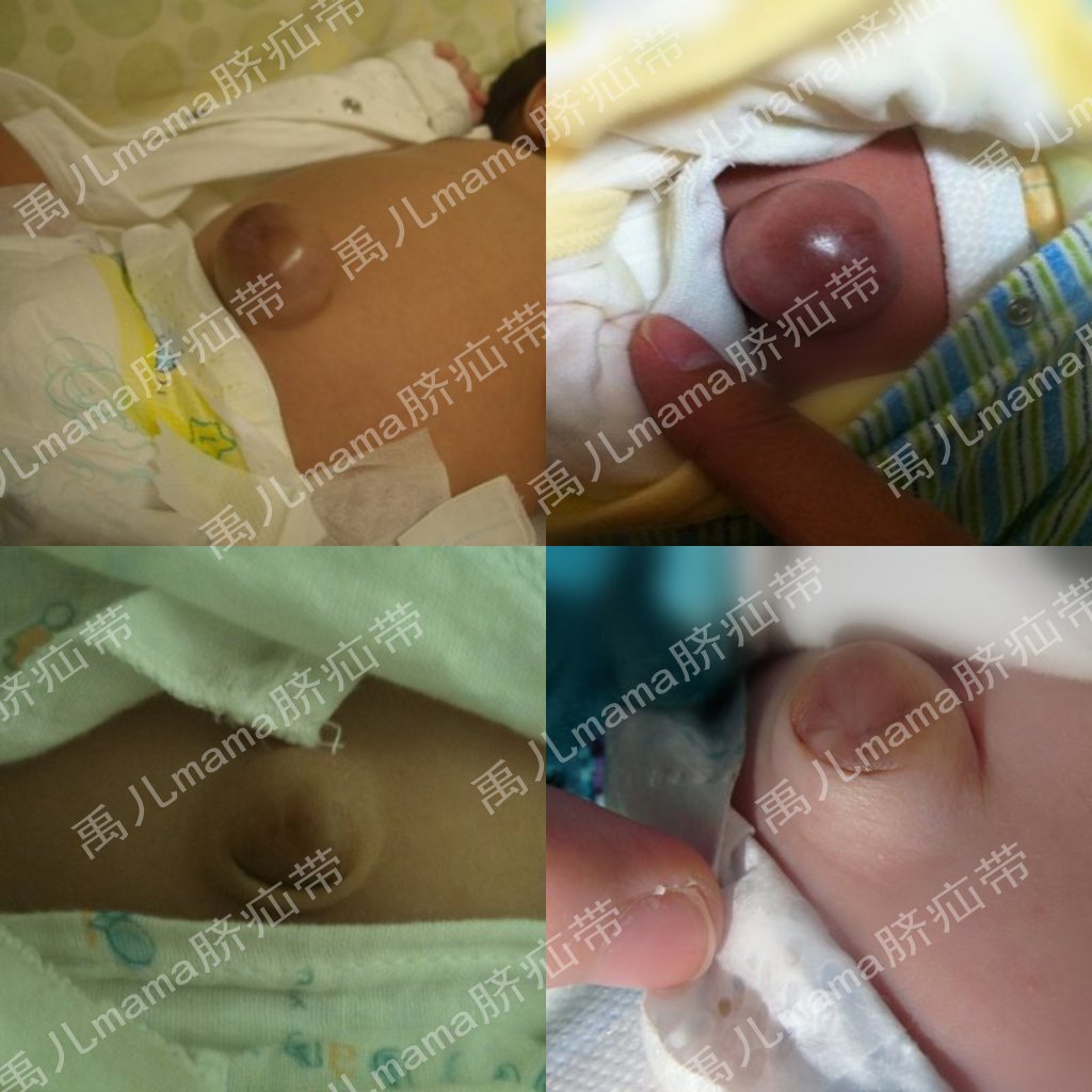 医疗器械加工-禹儿妈妈婴儿脐疝带\/护脐带\/气肚脐\/肚脐突出\/厂家供应\/脐疝带-医