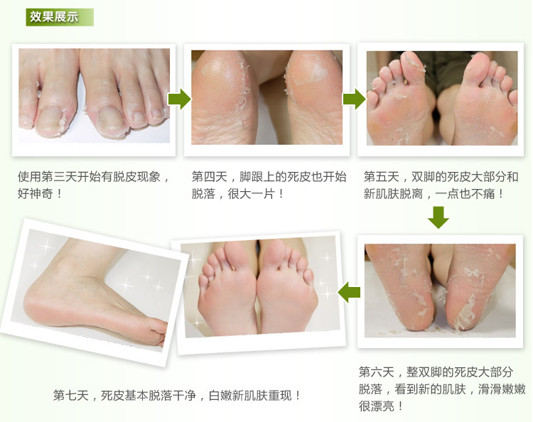 <em>杨四郎</em>四季嫩足液 脚气脚脱皮 脚水疱 脚汗脚臭