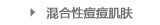 混合性痘痘肌肤