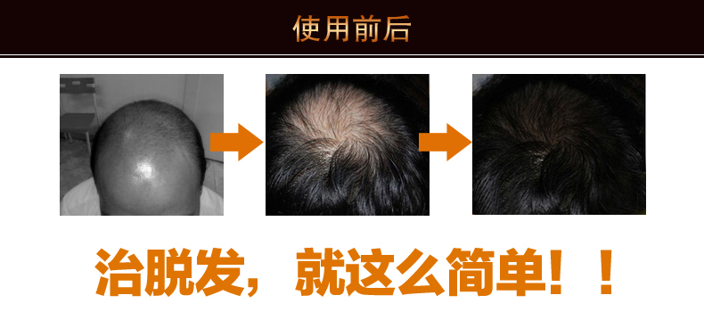 郑伊月生发液多少钱一套?_郑伊月生发液多少